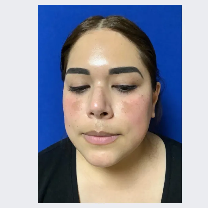 Before laser treatment